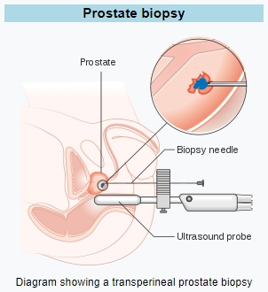 transperineal prostate biopsy